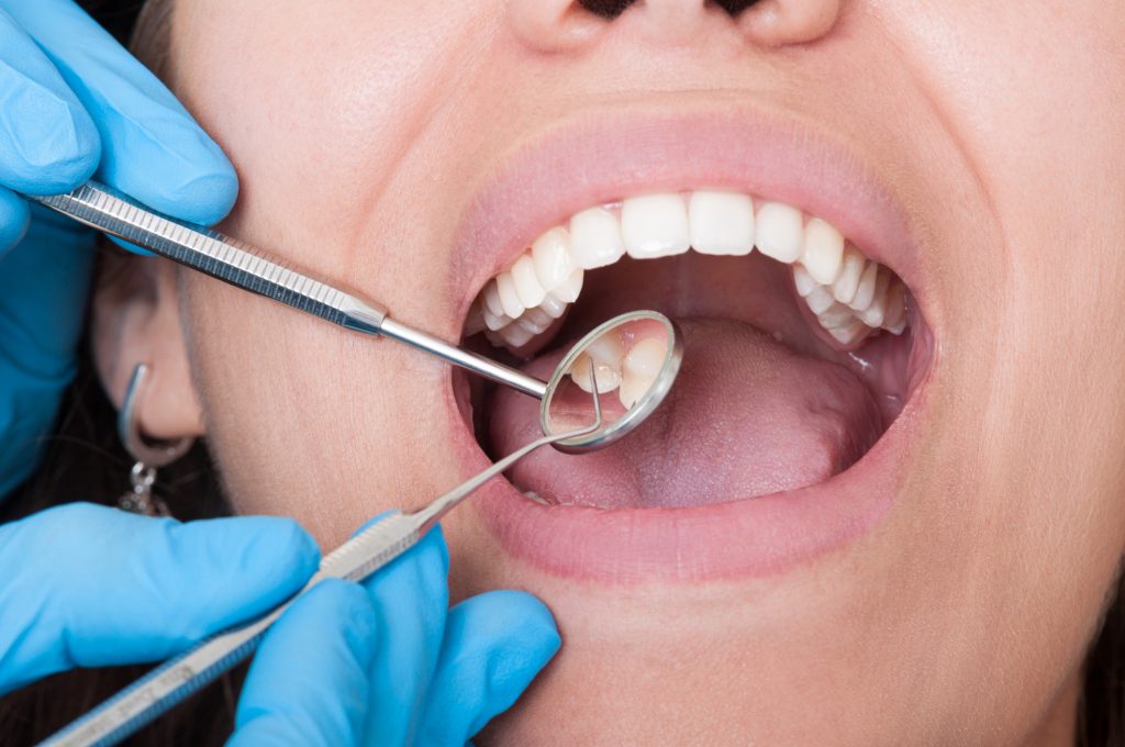 como saber si tengo caries